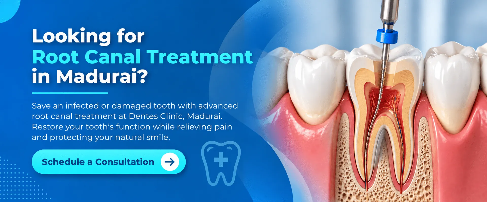 Root Canal Treatment in Madurai