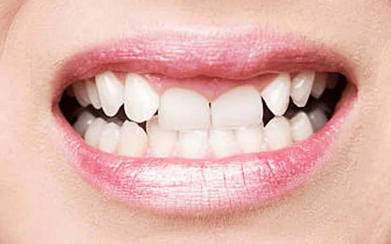 Invisalign Aligners in Madurai - Dentes Clinic
