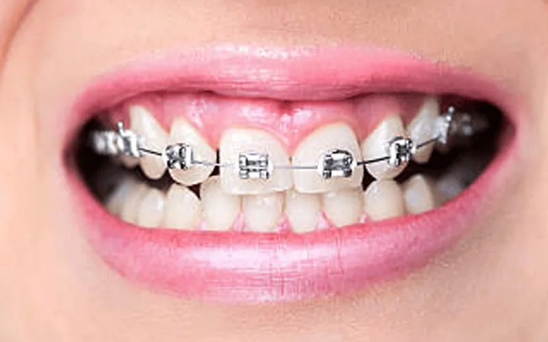Digital Smile Design in Madurai - Dentes Clinic