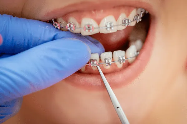 Flexible Dentures in Madurai - Dentes Clinic