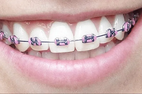 Best Invisalign Treatment in Madurai - Dentes Clinic