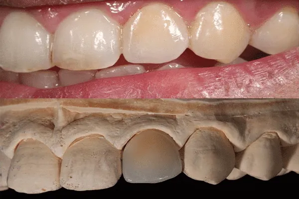 Implant-supported dentures for missing teeth