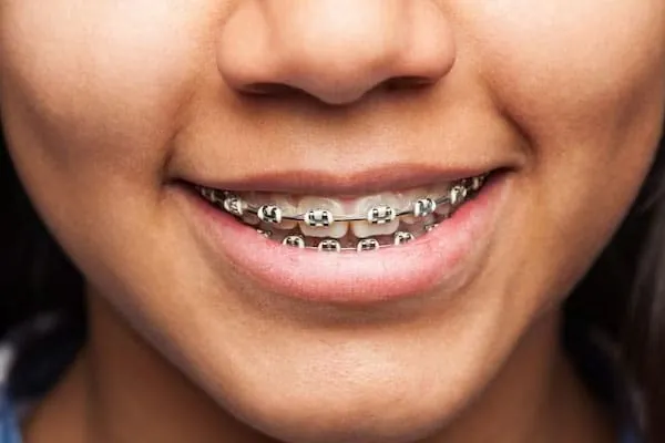 Invisalign Aligners in Madurai - Dentes Clinic