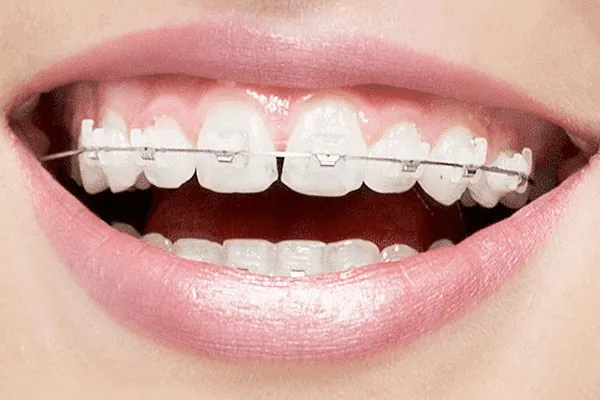 Clear orthodontic braces for discreet teeth alignment