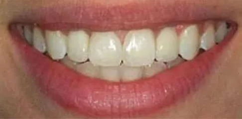 Treatment for closing gaps between teeth