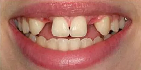 Digital Smile Design in Madurai - Dentes Clinic