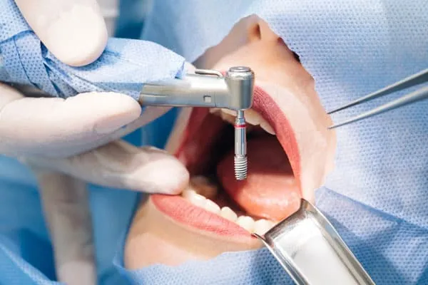 Best Dental Clinic in Madurai - Dentes Clinic