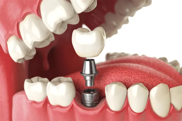 Digital planning for personalized smile enhancement