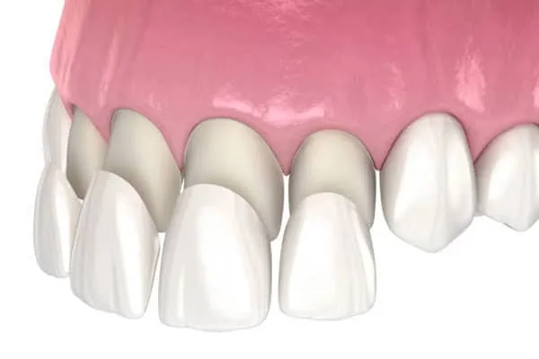 Dental Implants in Madurai - Dentes Clinic