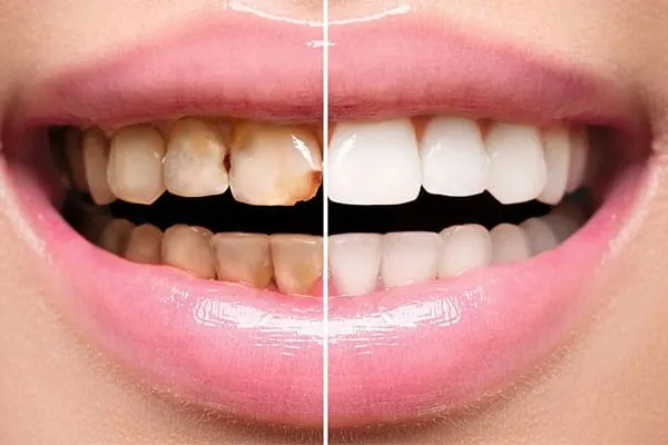 Smile Makeover in Madurai - Dentes Clinic