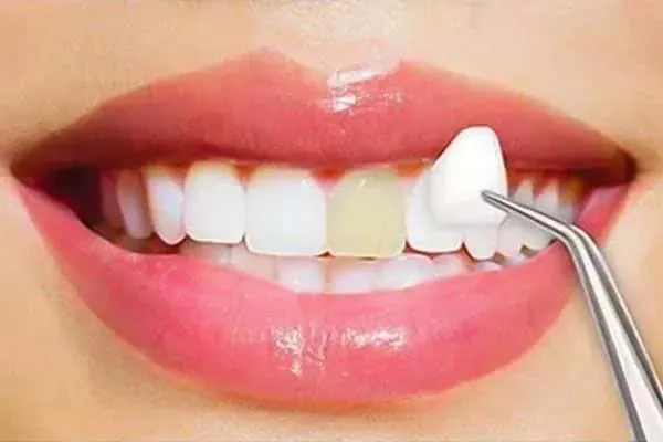 Dental Aligners in Madurai - Dentes Clinic