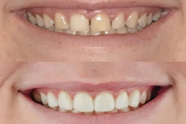 Dental Aligners in Madurai - Dentes Clinic