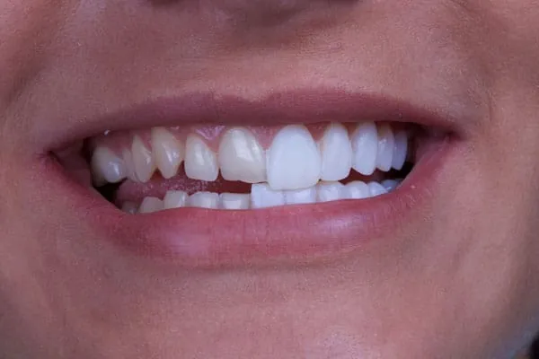 Clear Braces in Madurai - Dentes Clinic