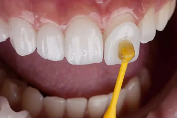 Invisible Braces in Madurai - Dentes Clinic