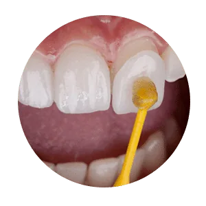 Best Invisalign Treatment in Madurai - Dentes Clinic