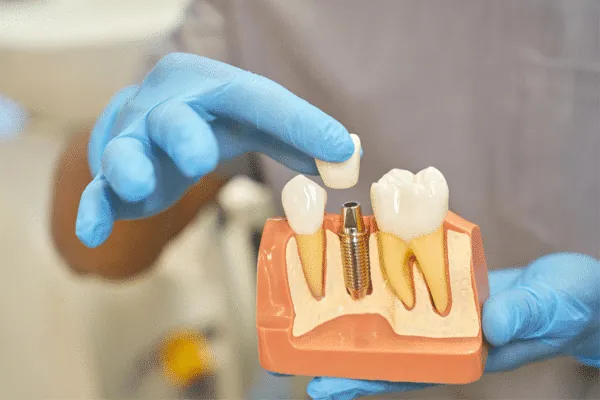 Ceramic Braces in Madurai - Dentes Clinic
