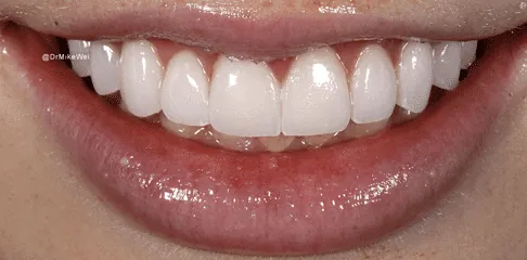 Denture Implants in Madurai - Dentes Clinic