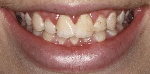 Dental Crowns in Madurai - Dentes Clinic
