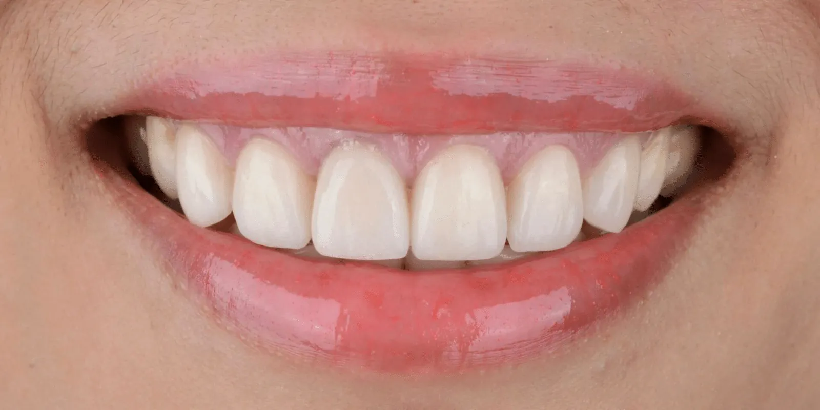 Flexible Dentures in Madurai - Dentes Clinic