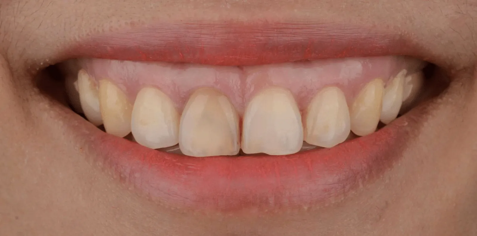 Dentures in Madurai - Dentes Clinic