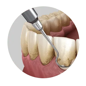 Comfortable flexible tooth replacement for missing teeth