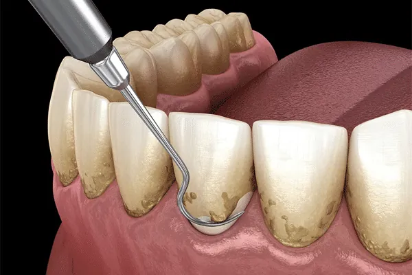Tooth-colored braces for teeth alignment