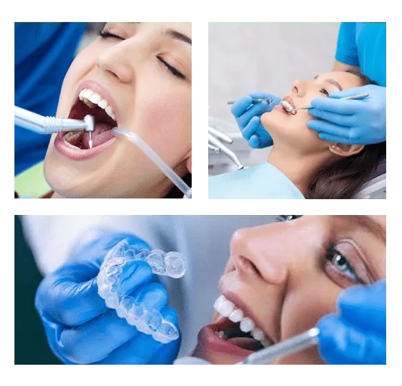 Tooth-colored braces for teeth alignment