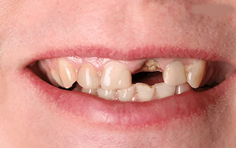 Dental Implants in Madurai - Dentes Clinic