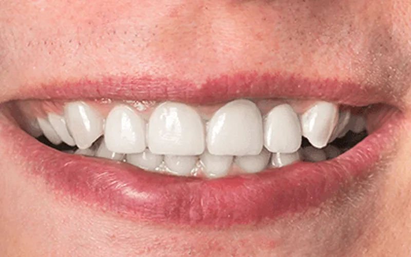 Teeth Whitening in Madurai - Dentes Clinic