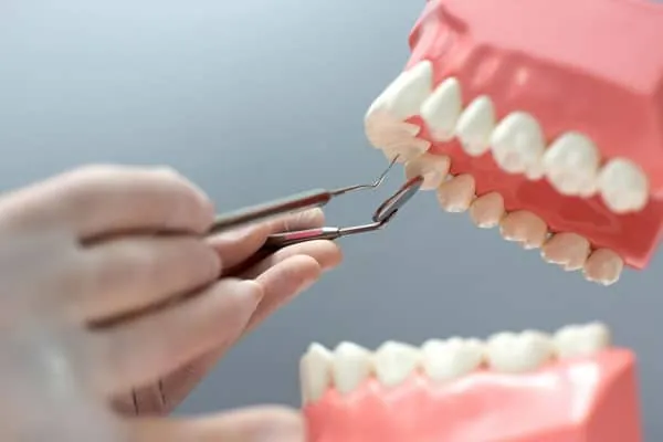 Dental Crowns in Madurai - Dentes Clinic