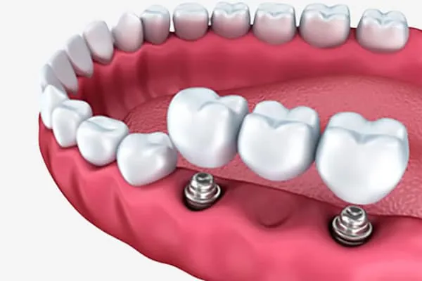 Remove Gaps in Teeth in Madurai - Dentes Clinic