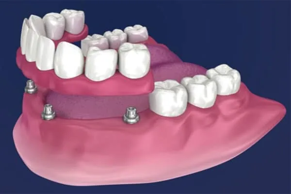 Dental Veneers in Madurai - Dentes Clinic
