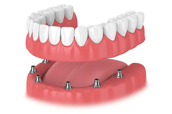 Tooth restoration with a custom dental crown