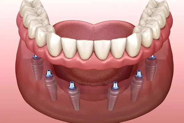 Dental Implants in Madurai - Dentes Clinic