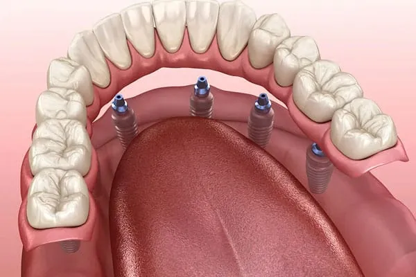 Smile Makeover in Madurai - Dentes Clinic