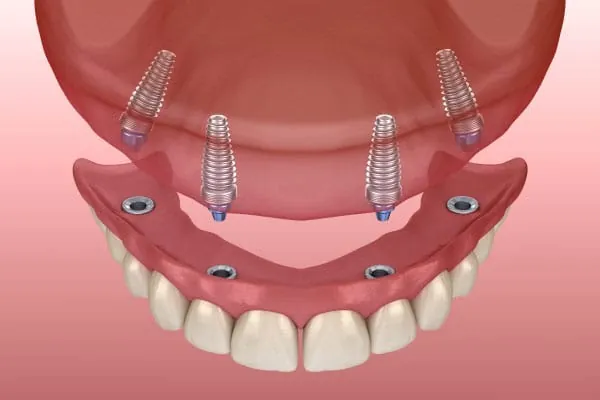 Dental Aligners in Madurai - Dentes Clinic