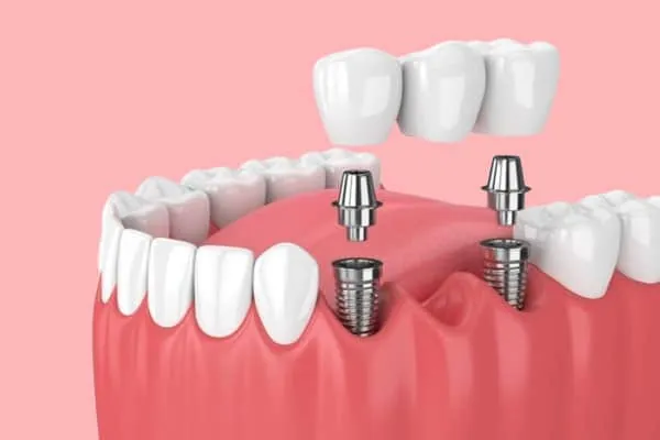 Denture Implants in Madurai - Dentes Clinic