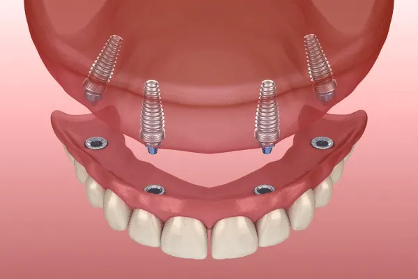 Dental Veneers in Madurai - Dentes Clinic