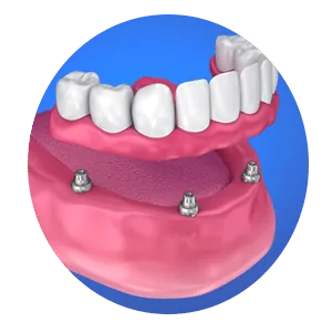 Best Invisalign Treatment in Madurai - Dentes Clinic