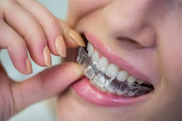 Best Invisalign Treatment in Madurai - Dentes Clinic