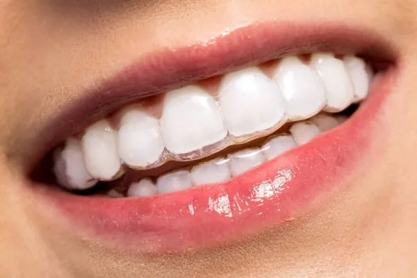 Smile Makeover in Madurai - Dentes Clinic