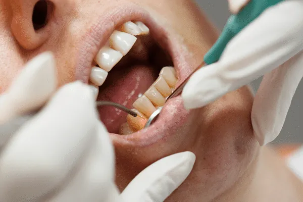 Permanent tooth replacement with dental implants