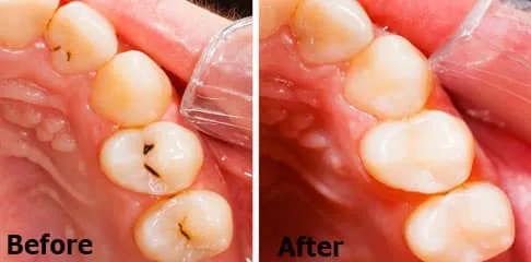Remove Gaps in Teeth in Madurai - Dentes Clinic