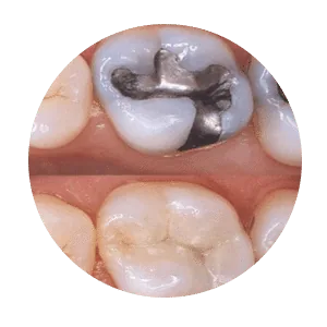 Clear aligner treatment for straighter teeth