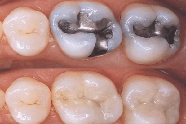 Clear aligner treatment for straighter teeth