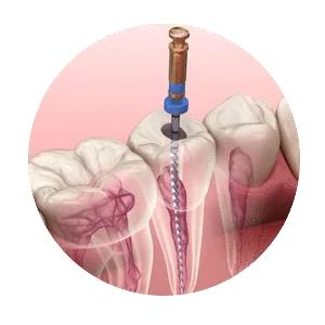 Flexible Dentures in Madurai