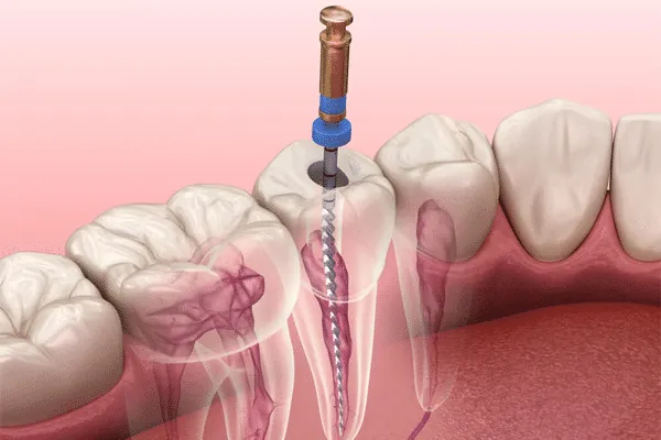 Comfortable flexible tooth replacement for missing teeth