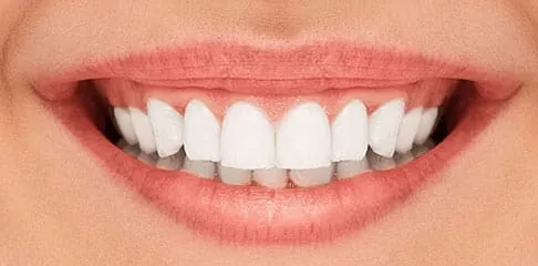 Dentures in Madurai - Dentes Clinic