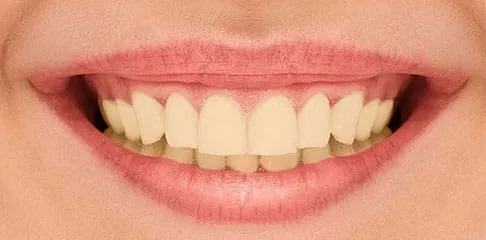 Flexible Dentures in Madurai - Dentes Clinic