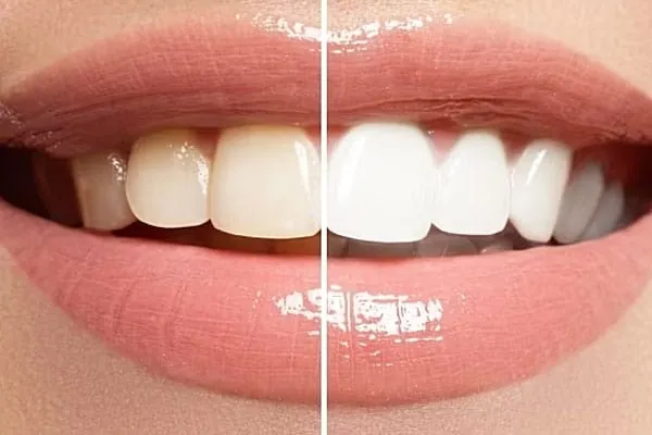 Invisalign Aligners in Madurai - Dentes Clinic